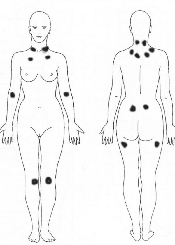 Cartel de Charla sobre fibromialgia